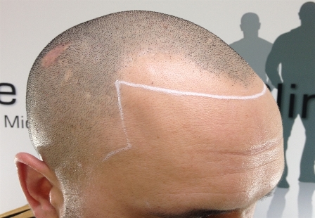 Receding Hairline Treatment for Men | Receding Hairline Transition using SMP