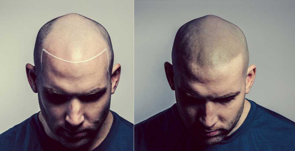 Shaved head shadow