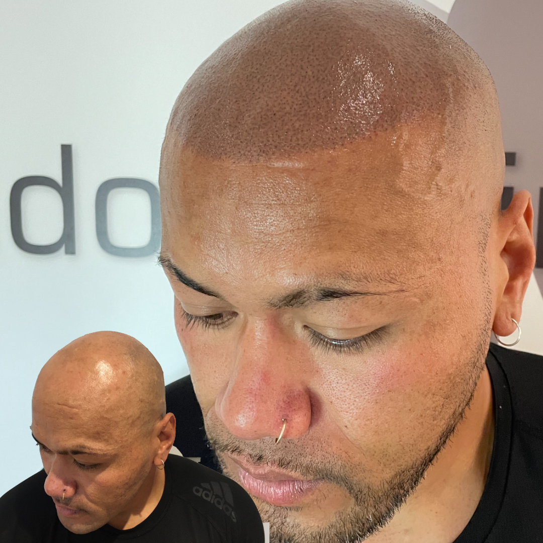 SMP For Men  Bald Head Hair Tattoo  Foli Sim