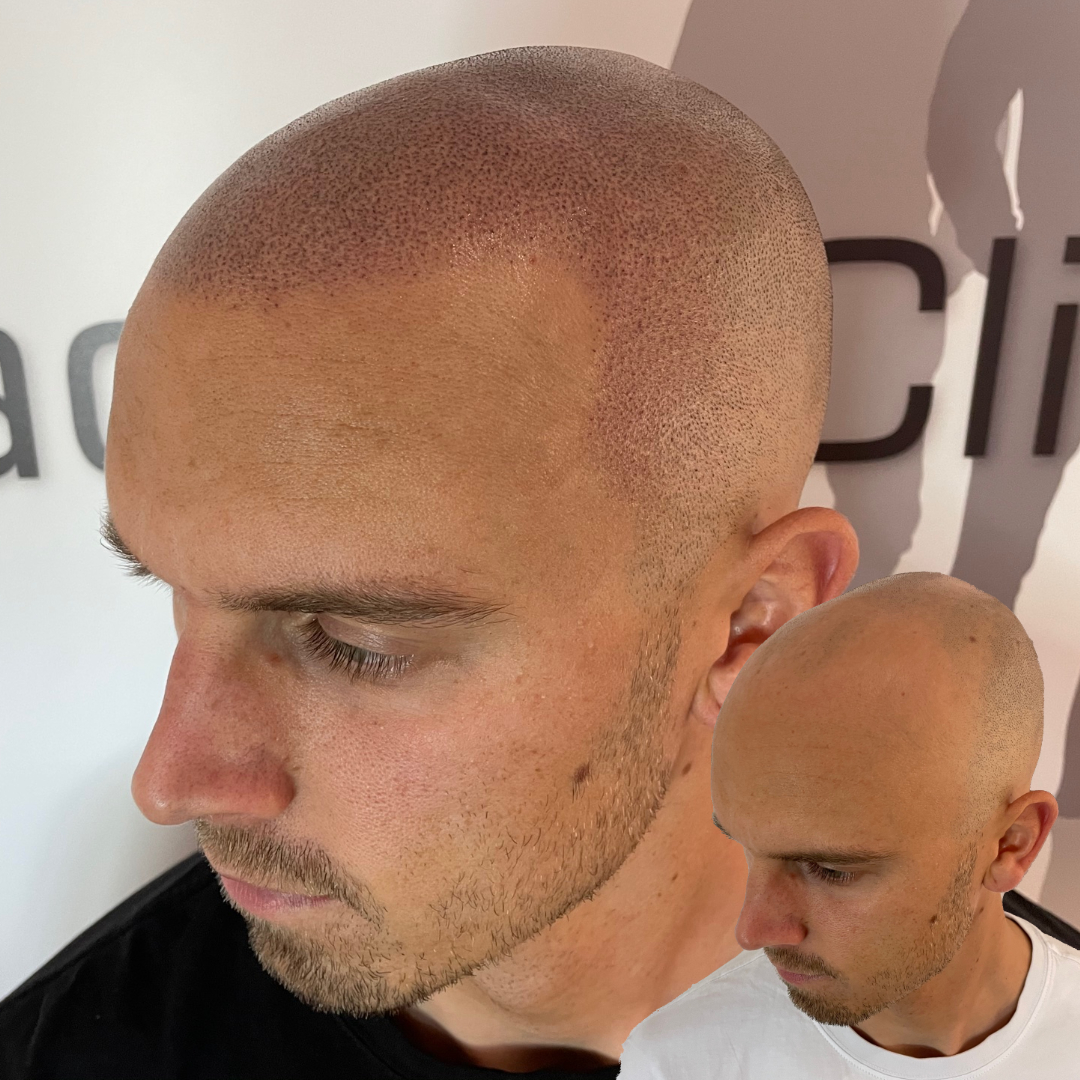 Scalp Micropigmentation: The Solution for Hair Loss in Kolkata