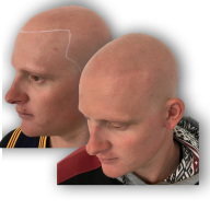 Alopecia Image