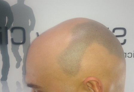 Image Alopecia Areata (Spot Baldness)