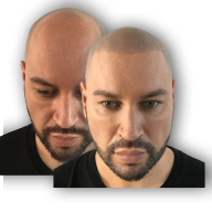 Male Pattern Baldness Image