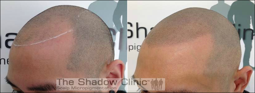Scalp Micro Pigmentation Treatment | Scalp Tattoo Micropigmentation & Tattooed  Hair