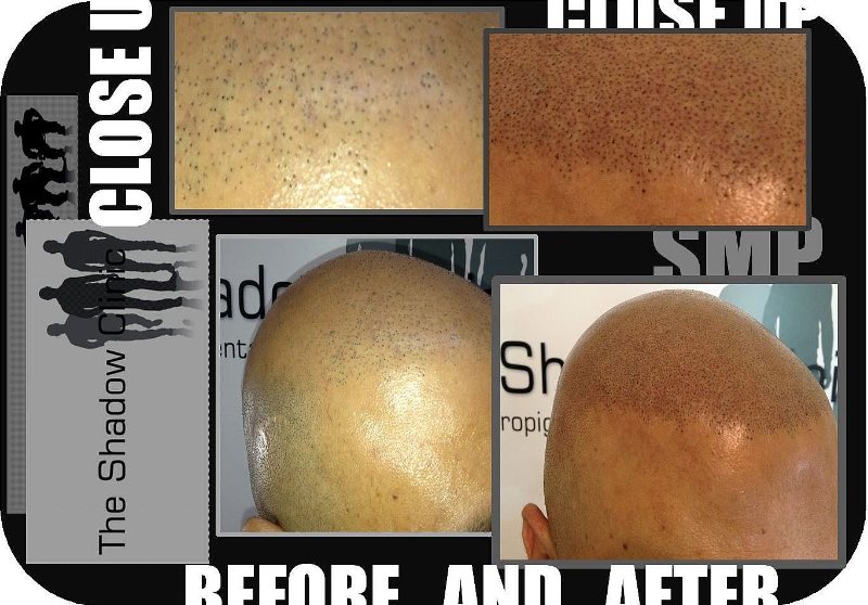 SMP_Density_for_Hair_Transplant